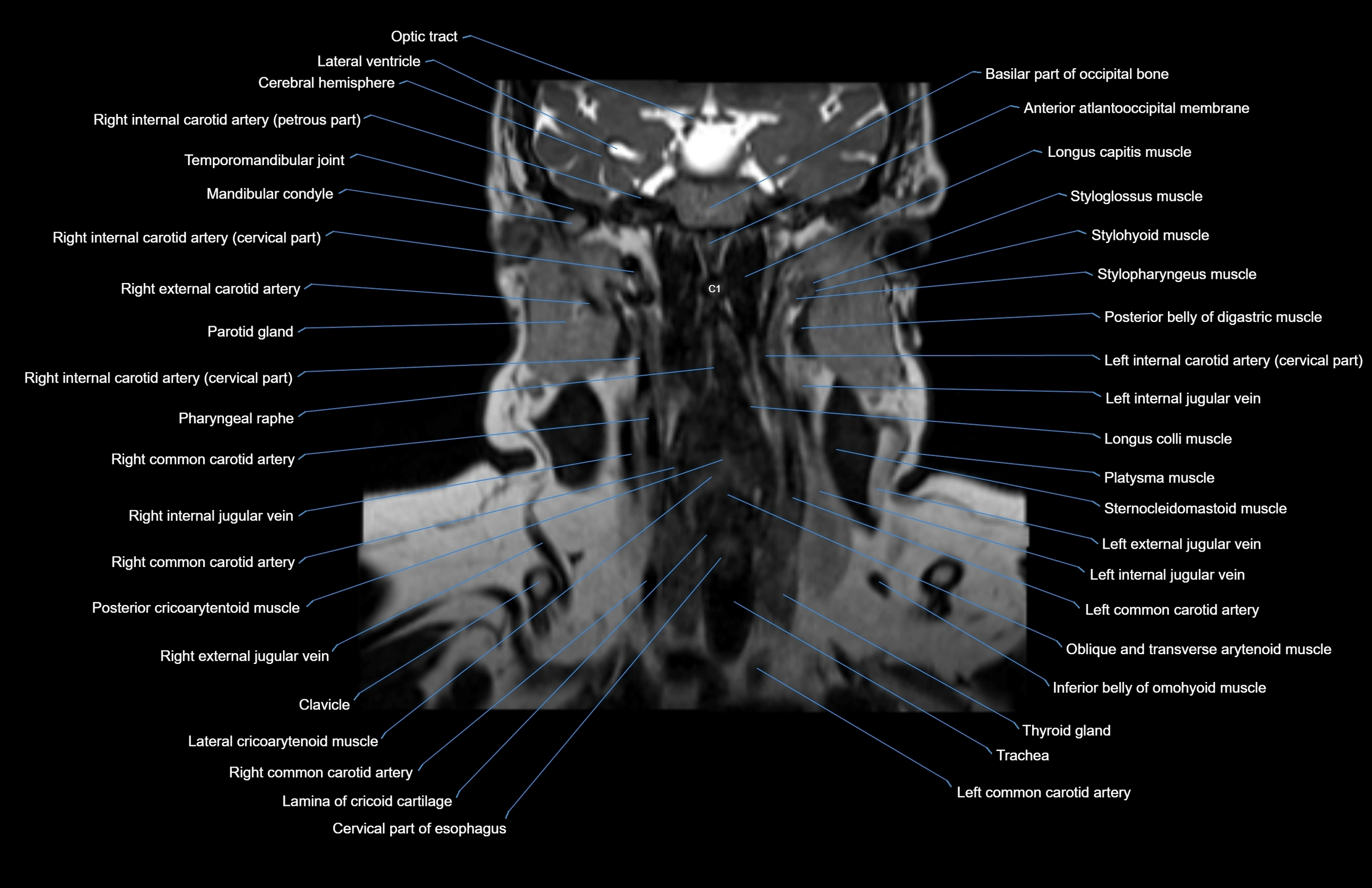 Neck coronal cross sectional MRI anatomy 3T MRI  image-img-00001-00037.webp